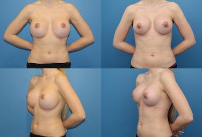 Mal-position- Inferior and/or Lateral Before & After Gallery - Patient 2388917 - Image 1