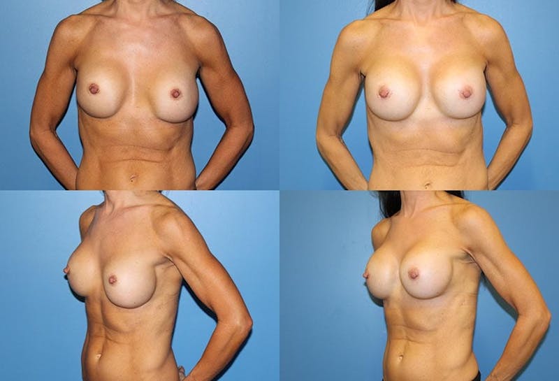 Breast Revision Surgery Before & After Gallery - Patient 2158781 - Image 1