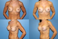 Mal-position- Inferior and/or Lateral Before & After Gallery - Patient 2388919 - Image 1