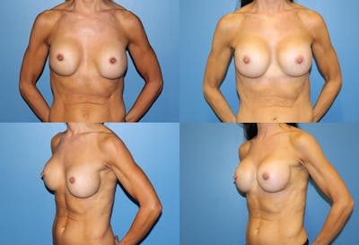 Breast Revision Surgery Before & After Gallery - Patient 2158781 - Image 1