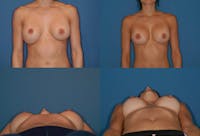 Mal-position- Inferior and/or Lateral Before & After Gallery - Patient 2388921 - Image 1
