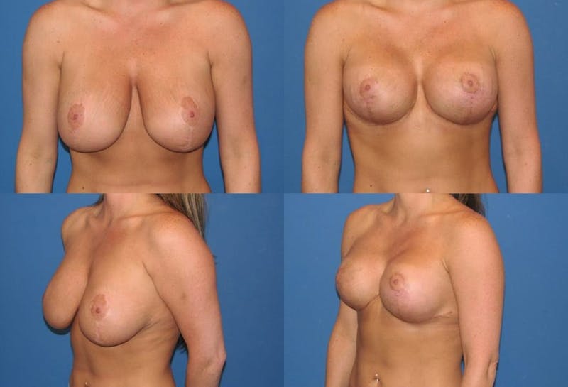 Breast Revision Surgery Before & After Gallery - Patient 2158785 - Image 1