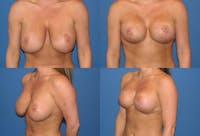 Breast Revision Surgery Before & After Gallery - Patient 2158785 - Image 1