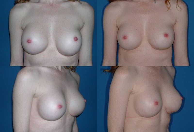 Breast Revision Surgery Before & After Gallery - Patient 2158790 - Image 1