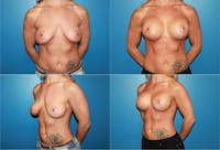 Mal-position- Inferior and/or Lateral Before & After Gallery - Patient 2388930 - Image 1