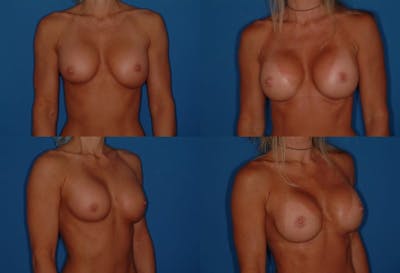 Breast Revision Surgery Before & After Gallery - Patient 2158795 - Image 1