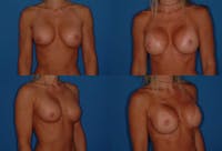 Mal-position- Inferior and/or Lateral Before & After Gallery - Patient 2388931 - Image 1