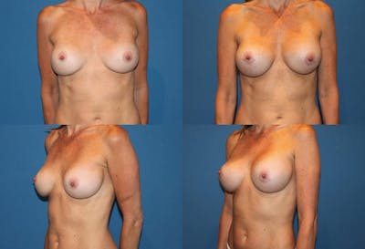 Mal-position- Inferior and/or Lateral Before & After Gallery - Patient 2388934 - Image 1