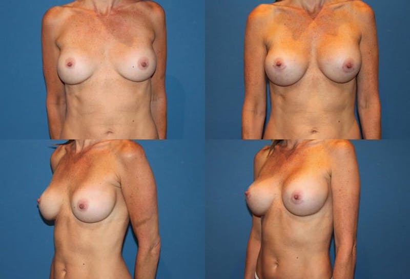 Mal-position- Inferior and/or Lateral Before & After Gallery - Patient 2388934 - Image 1