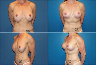 Mal-position- Inferior and/or Lateral Before & After Gallery - Patient 2388937 - Image 1