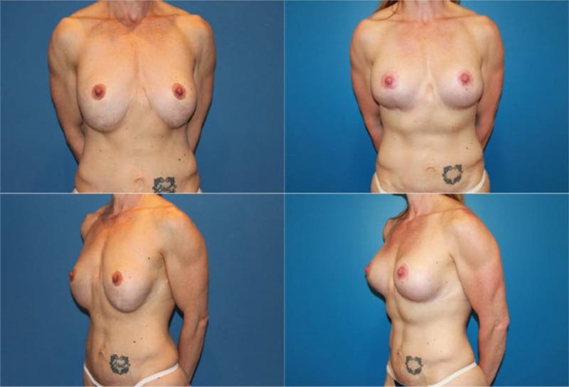 Mal-position- Inferior and/or Lateral Before & After Gallery - Patient 2388937 - Image 1