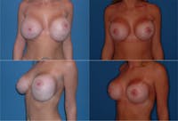 Breast Revision Surgery Before & After Gallery - Patient 2158803 - Image 1