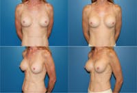 Breast Revision Surgery Before & After Gallery - Patient 2158804 - Image 1