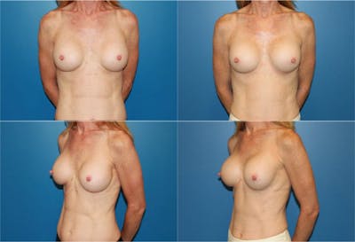 Mal-position- Inferior and/or Lateral Before & After Gallery - Patient 2388939 - Image 1