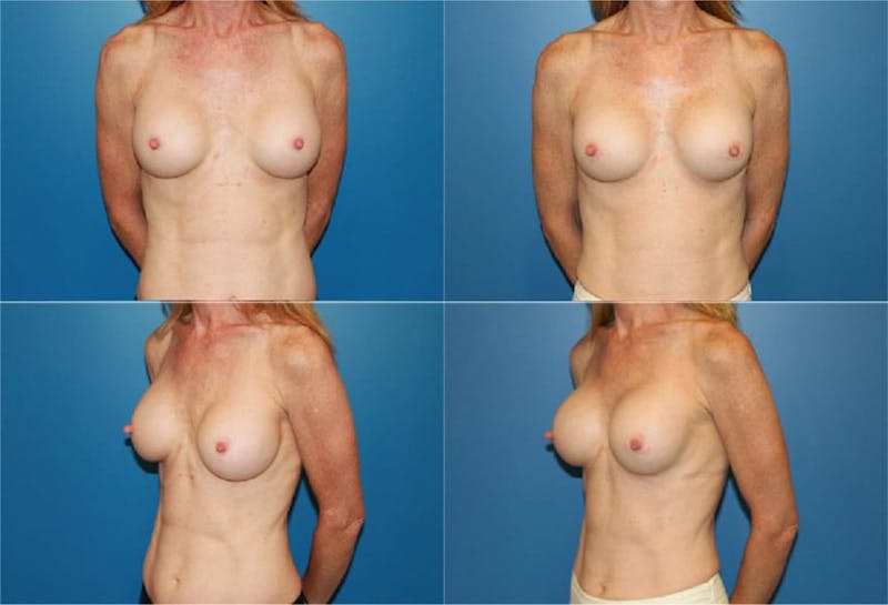 Mal-position- Inferior and/or Lateral Before & After Gallery - Patient 2388939 - Image 1