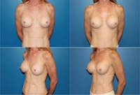 Breast Revision Surgery Gallery - Patient 2158804 - Image 1