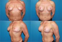 Breast Revision Surgery Before & After Gallery - Patient 2158807 - Image 1