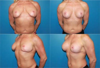 Mal-position- Inferior and/or Lateral Before & After Gallery - Patient 2388941 - Image 1