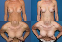 Mal-position Medial/Symmastia Before & After Gallery - Patient 2389066 - Image 1