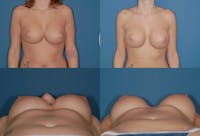 Mal-position Medial/Symmastia Before & After Gallery - Patient 2389067 - Image 1
