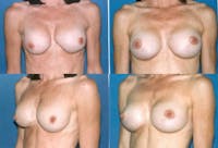 Breast Revision Surgery Before & After Gallery - Patient 2158816 - Image 1