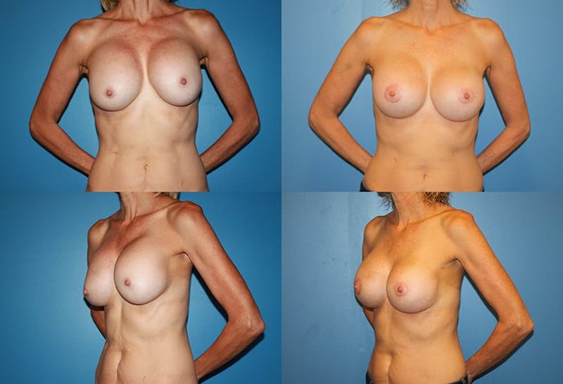 Breast Revision Surgery Before & After Gallery - Patient 2158818 - Image 1