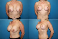 Breast Revision Surgery Before & After Gallery - Patient 2158821 - Image 1