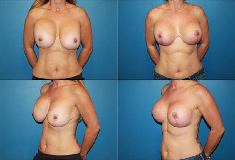 Breast Revision Surgery Before & After Gallery - Patient 2158825 - Image 1