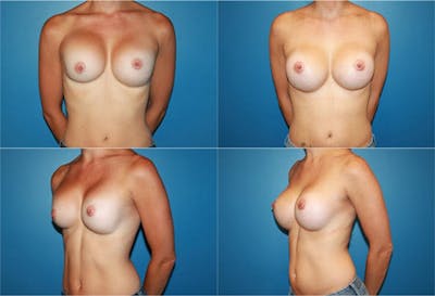 Breast Revision Surgery Before & After Gallery - Patient 2158826 - Image 1