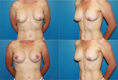 Breast Revision Surgery Before & After Gallery - Patient 2158827 - Image 1