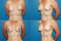 Breast Revision Surgery Before & After Gallery - Patient 2158827 - Image 1