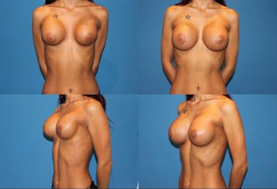 Breast Revision Surgery Before & After Gallery - Patient 2158828 - Image 1