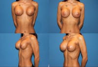 Breast Revision Surgery Before & After Gallery - Patient 2158828 - Image 1