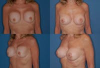 Breast Revision Surgery Before & After Gallery - Patient 2158829 - Image 1