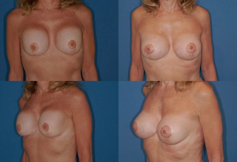 Breast Revision Surgery Before & After Gallery - Patient 2158829 - Image 1
