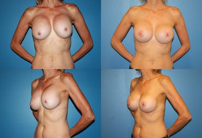 Breast Revision