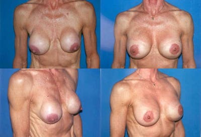 Capsular Contracture Before & After Gallery - Patient 2393547 - Image 1