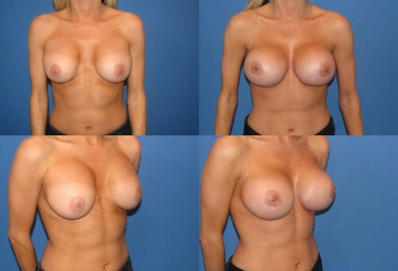 Capsular Contracture Before & After Gallery - Patient 2393548 - Image 1