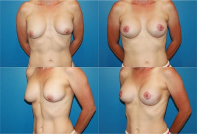 Capsular Contracture Before & After Gallery - Patient 2393550 - Image 1