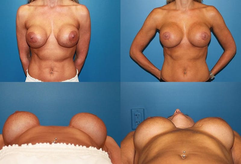Breast Revision Surgery Gallery - Patient 2158844 - Image 1