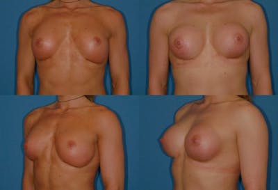 Capsular Contracture Before & After Gallery - Patient 2393555 - Image 1