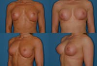 Capsular Contracture Gallery - Patient 2393555 - Image 1