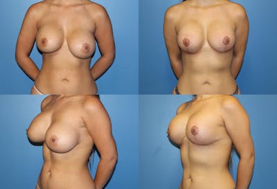 Asymmetry Before & After Gallery - Patient 2393788 - Image 1