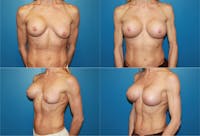 Breast Revision Surgery Before & After Gallery - Patient 2158852 - Image 1