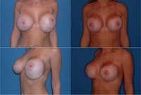 Asymmetry Before & After Gallery - Patient 2393792 - Image 1