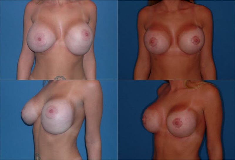 Breast Revision Surgery Before & After Gallery - Patient 2158854 - Image 1