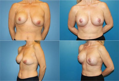 Breast Revision Surgery Gallery - Patient 2158855 - Image 1