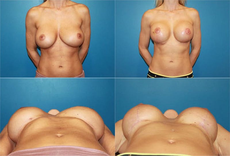 Breast Revision Surgery Before & After Gallery - Patient 2158856 - Image 1