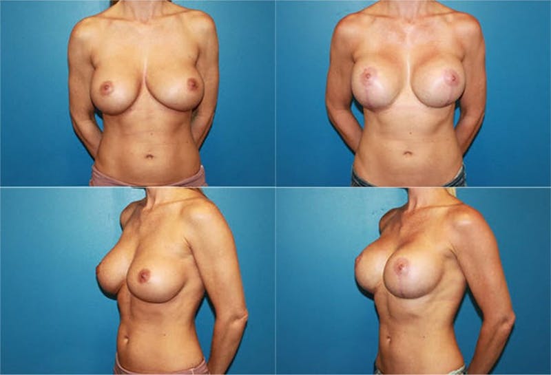 Breast Revision Surgery Before & After Gallery - Patient 2158857 - Image 1