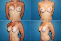 Asymmetry Before & After Gallery - Patient 2393796 - Image 1